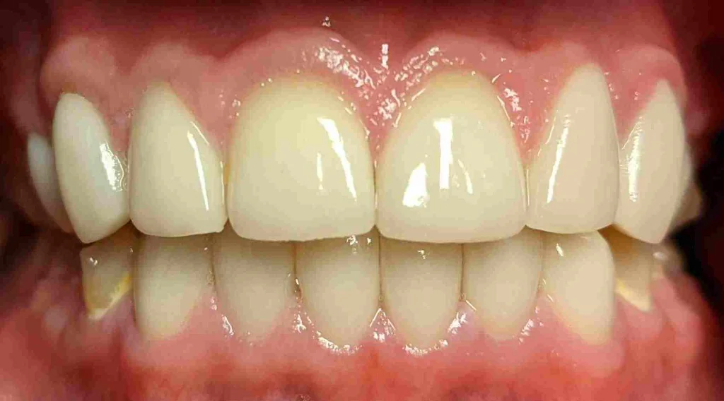 After Smile Design, case 3