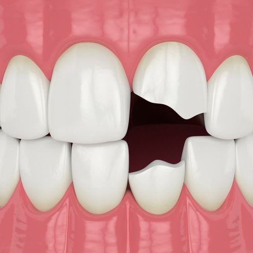Illustration of chipped and broken front teeth