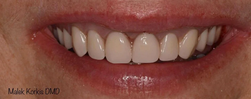 After Smile Design, case 1