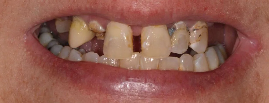 Before Smile Design, case 1