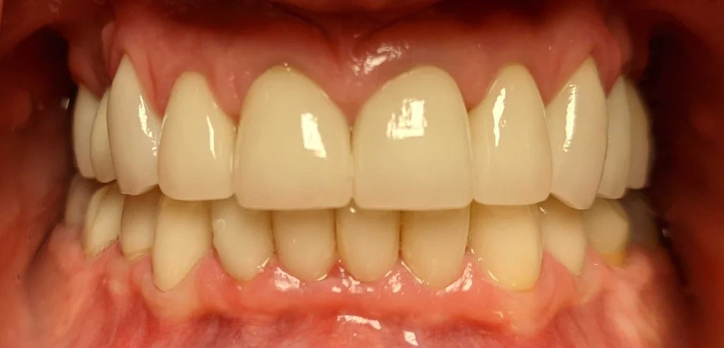 After Smile Design, case 2