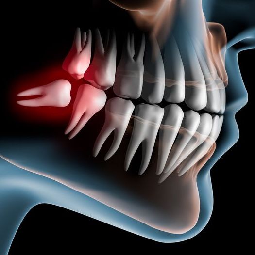 Side-view illustration of a jaw with an impacted wisdom tooth highlighted in red