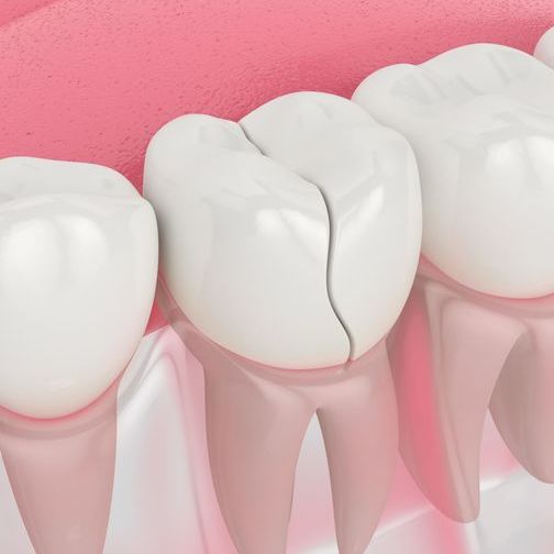 Illustration of a molar with a crack running through it