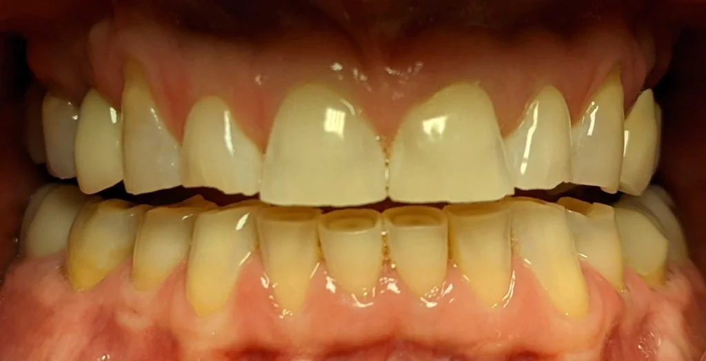 Before Smile Design, case 2